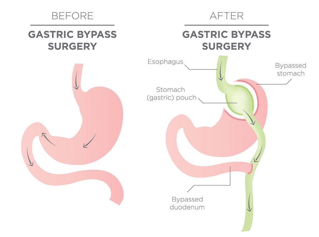 Gastric Bypass Surgery Diagram